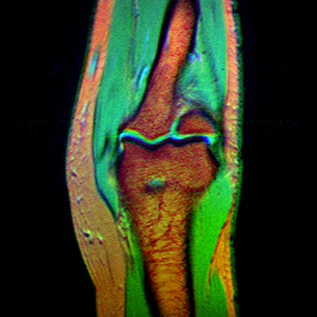 Как проходит МРТ нижних конечностей: ноги, бедра, голени и стопы 