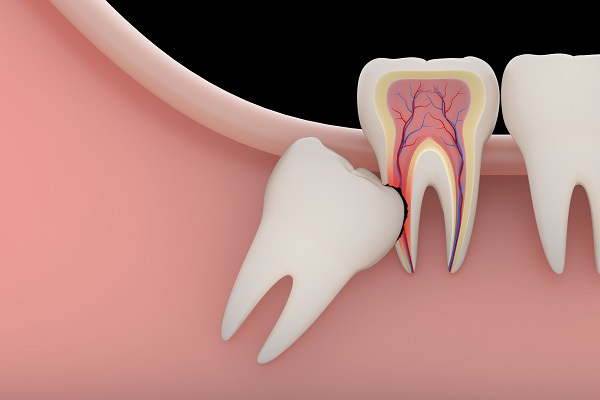 Как проводится сложное удаление зуба 