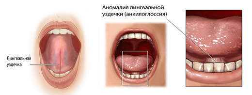 Как врач делает пластику уздечки языка лазером у детей и взрослых 