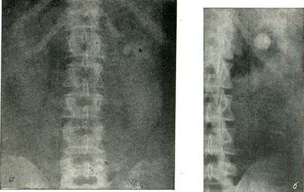 Обзорная рентгенография органов мочевой системы 