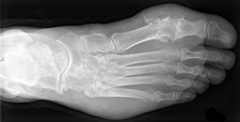 Рентгенография и рентгенограмма голеностопного сустава 
