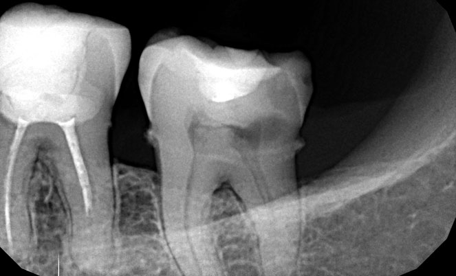 Рентген (рентгенография) зуба 