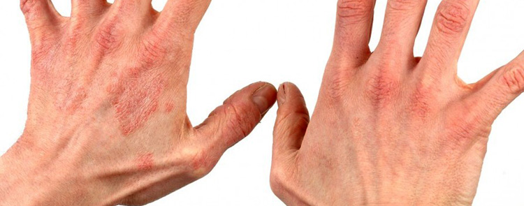 Аллергия на кистях рук: причины, симптомы и что делать 