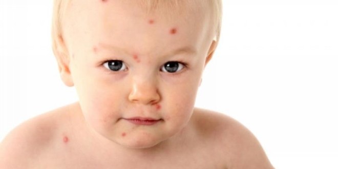 Аллергия у детей: виды, причины, симптомы и лечение в зависимости от разновидности 