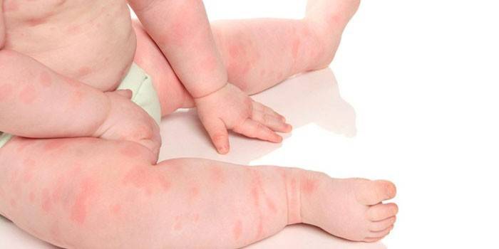 Аллергия у новорожденного грудничка: как определить и чем помочь малышу 