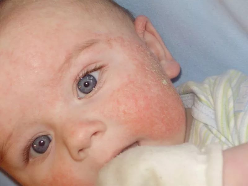 Аллергия у ребенка: как определить и чем помочь малышу 