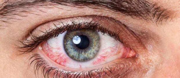 Эффективные методы лечения аллергии вокруг глаз при помощи антигистаминных препаратов и народных средств 