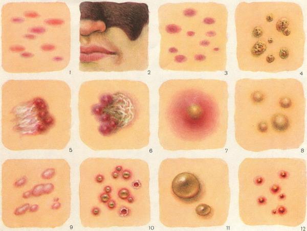 Формы аллергической сыпи на коже и методы лечения 