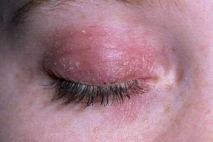 Признаки аллергического дерматита на коже век, методы лечения 