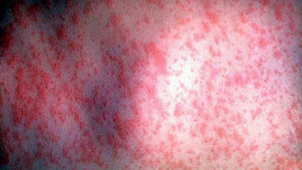 Симптомы аллергии на антибиотики 
