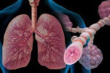 Симптомы и лечение аллергической (атопической) астмы 