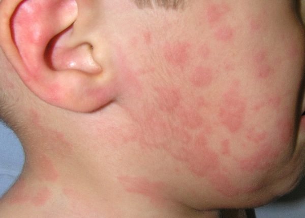 Средства от аллергии на солнце для детей и взрослых 