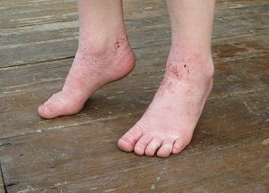 Тяжёлое нервно-аллергическое заболевание — экзема на ногах: фото начальной стадии, терапия патологии и способы снижения частоты обострений 