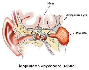 Невринома слухового нерва: симптомы, лечение и особенности опухоли 