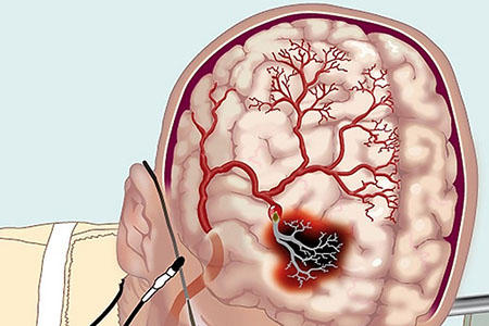 Остеохондроз – нарушитель мозгового кровообращения 