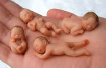 Что представляет собой редукция эмбриона? 