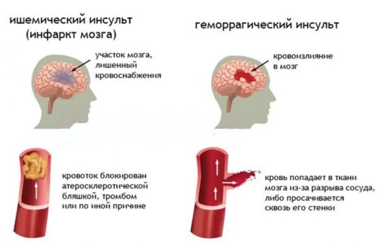 Вся правда о геморрагическом инсульте головного мозга: чем он опасен и как его лечить 