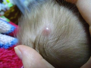 Атерома (эпидермальная киста кожи) у ребенка или взрослого: ответы на основные вопросы 
