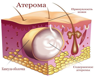 Атерома молочных желез и соска: симптомы и лечение 