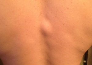 Атерома на спине: фото, лечение 