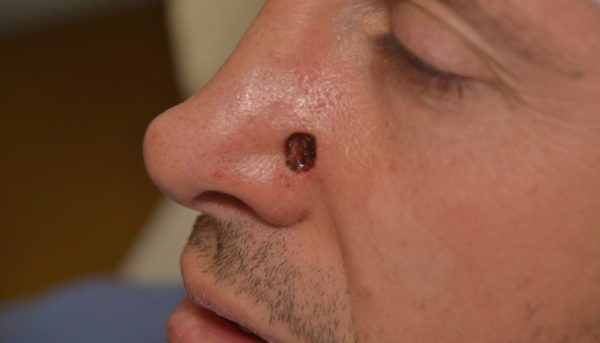 Базалиома кожи носа — раковая опухоль, но не приговор 