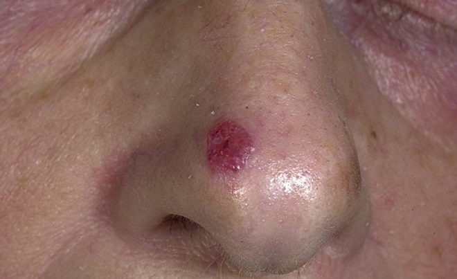 Базалиома носа: поражения слизистой кожи, операция по удалению на начальной стадии 