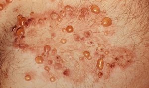 Буллезный дерматит : особенности патологии, характерные признаки, лечение 