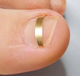 Быстрая и безболезненная лазерная коррекция вросшего ногтя: все, что нужно знать 