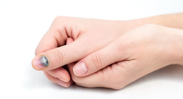 Черные полоски на ногтях: причины, лечение 