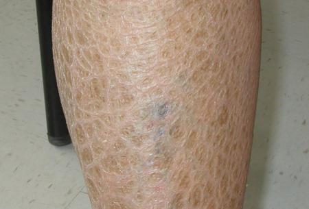 Что такое ихтиоз кожи, и можно ли вылечить это заболевание 