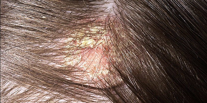 Что такое себорейный и другие виды дерматита кожи головы? Рекомендации по лечению и диете 