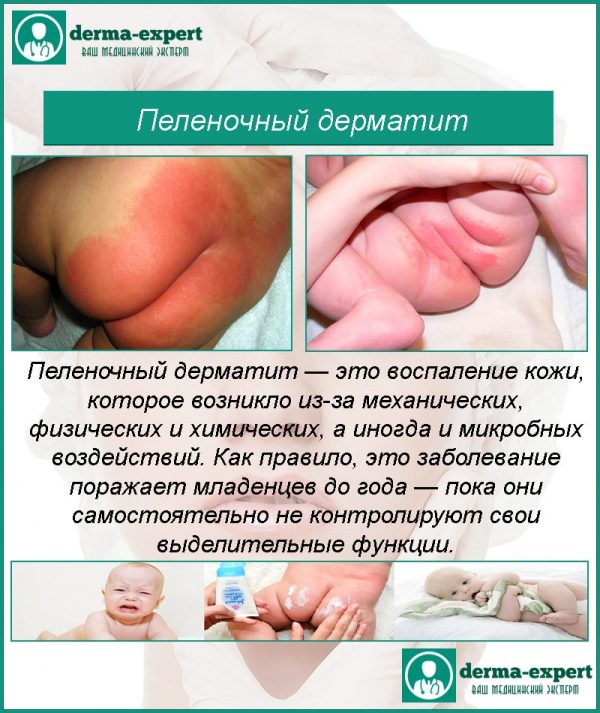 Дерматит у новорожденных лечение 