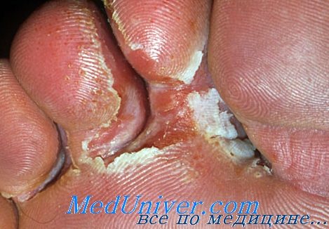 Дерматофития: симптомы и лечение, фото поражения ногтей и ступней 