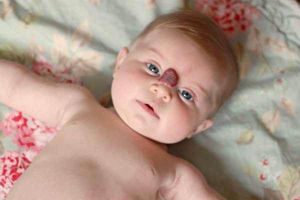 Гемангиома у новорождённых — обследуем и лечим 