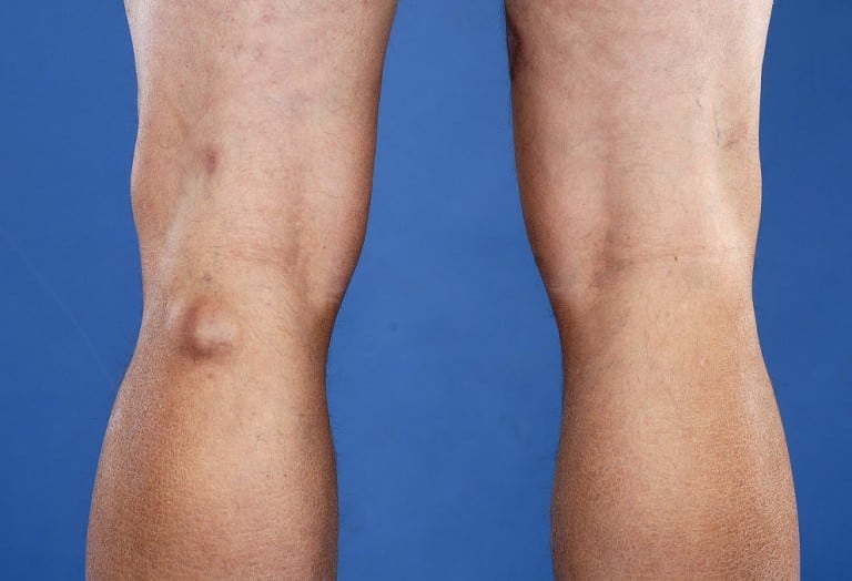 Киста Бейкера коленного сустава: лечение, причины и симптомы 