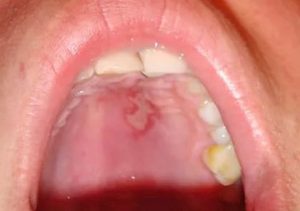 Ожог слизистой полости рта: причины и лечение 