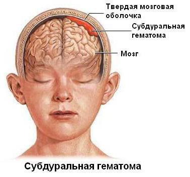Поражение головного мозга: понятие субдypaльной гематомы 
