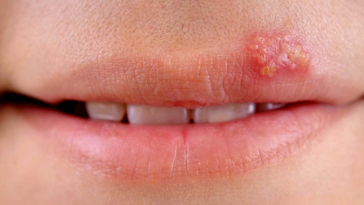 Герпес на губах — от чего появляется и как лечить 