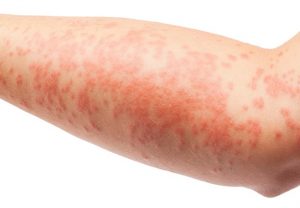 Инфекционный дерматит: когда сыпь – всего лишь один из симптомов 