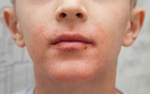 Как бороться с сухой кожей вокруг рта 