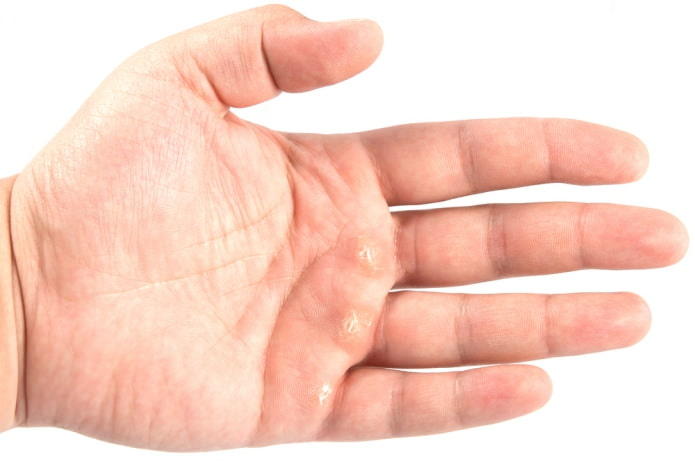 Как лечить мозоли на пальцах рук 