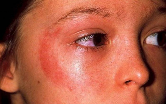 Как проявляется аллергия на солнце, первая помощь и методы лечения 