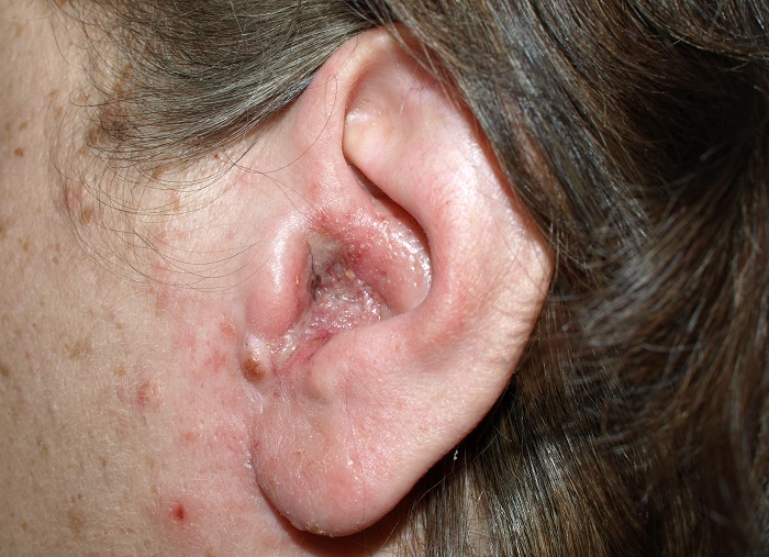 Как распознать появление гepпeса в ухе или за ушами? 