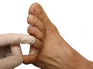 Как удалить мозоль на ноге между пальцами? Аптечные средства и народные методы лечения 