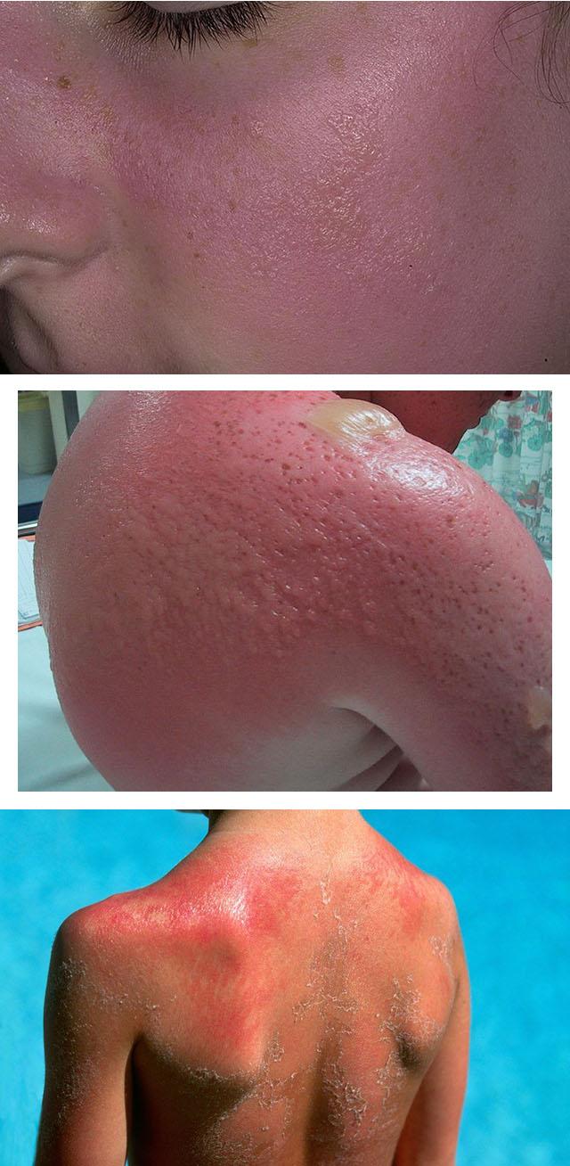 Как выглядит солнечный дерматит, почему кожа реагирует на солнце и чем опасна такая реакция? 
