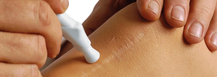Келоидный рубец: причины появления на коже и способы его лечения 