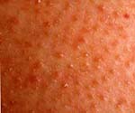 Лечение гусиной кожи или фолликулярного гиперкератоза 