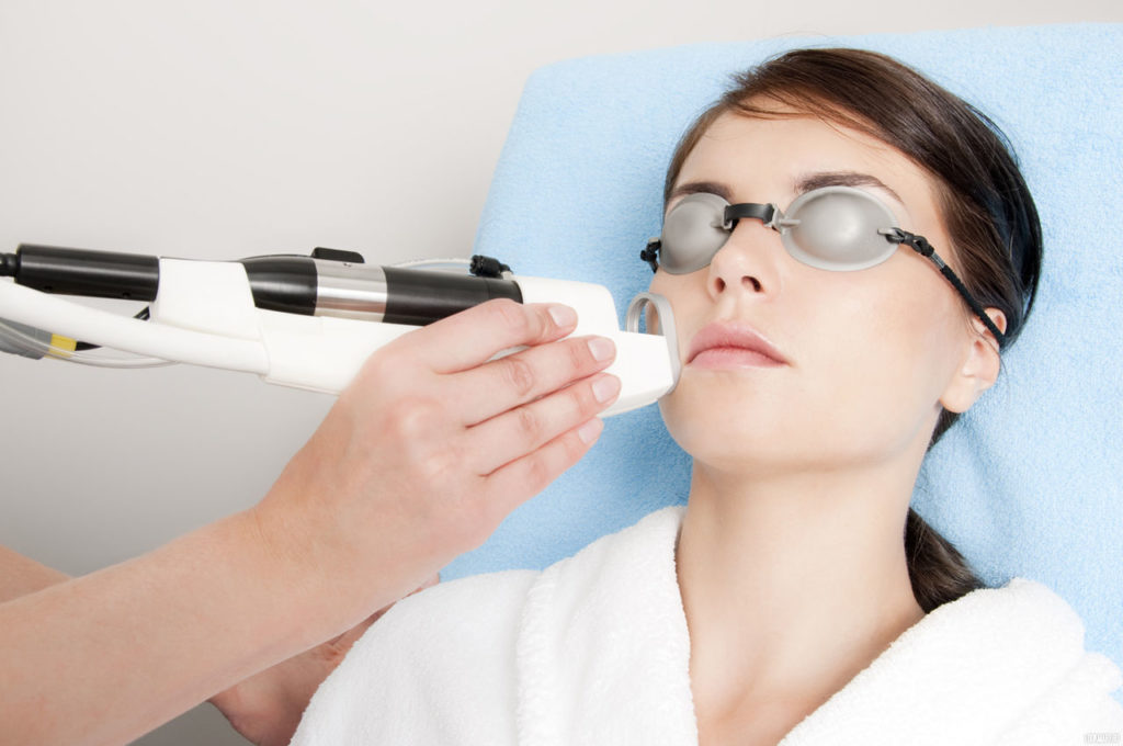 Лечение купероза на лице лазером — все, что нужно знать о процедуре 