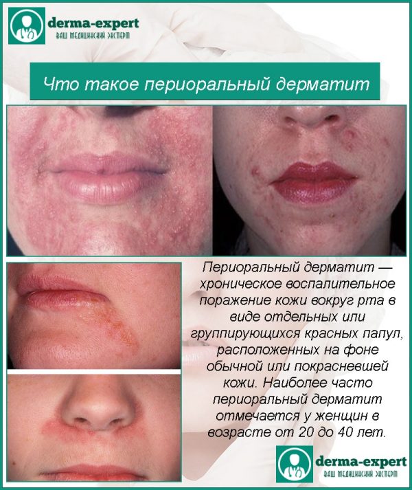 Лечение перopaльного дерматита на лице 