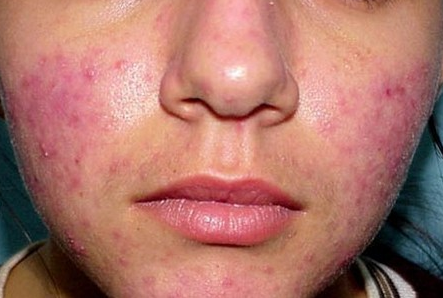 Лечение розовых угрей на лице, их фото 